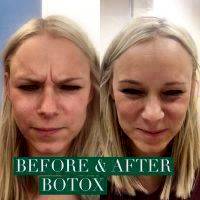 Liquid Facelift With Botox Before And After