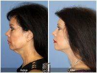 Lower Face And Neck Lift Before And After Photos (10)