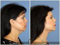 Lower Face And Neck Lift Before And After Photos (9)