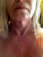 Lower Face And Neck Lift Is An Operation To Improve The Loose Skin Of The Neck, The Jaw Line, The Deeper Wrinkle Lines