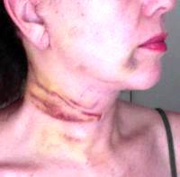 Lower Face And Neck Lift May Be Part Of A Number Of Procedures