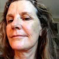 Lower Face And Neck Lift Pictures (11)