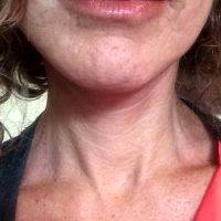 Lower Face And Neck Lift Pictures (13)
