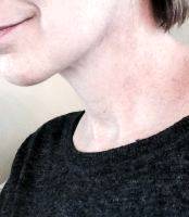 Lower Face And Neck Lift Pictures (15)