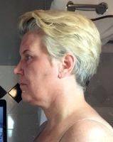 Lower Face And Neck Lift Pictures (16)