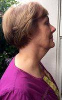 Lower Face And Neck Lift Pictures (20)