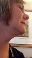 Lower Face And Neck Lift Pictures (22)