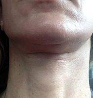 Lower Face And Neck Lift Pictures (24)