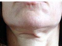 Lower Face And Neck Lift Pictures (25)