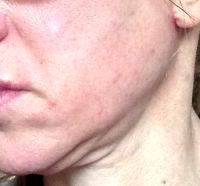 Lower Face And Neck Lift Pictures (26)