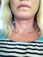 Lower Face And Neck Lift Pictures (3)