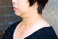 Lower Face And Neck Lift Pictures (33)