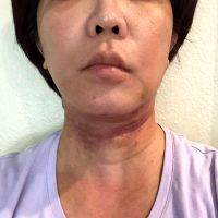 Lower Face And Neck Lift Pictures (34)