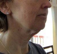 Lower Face And Neck Lift Pictures (37)