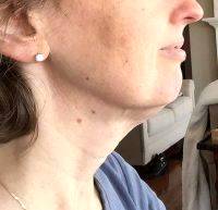Lower Face And Neck Lift Pictures (38)