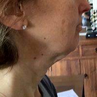 Lower Face And Neck Lift Pictures (39)