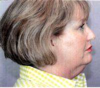 Lower Face And Neck Lift Pictures (8)