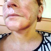 Lower Face And Neck Lift Recovery Photos (1)