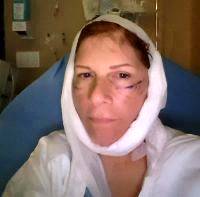 Lower Face And Neck Lift Recovery Photos (2)