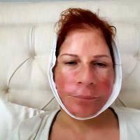 Lower Face And Neck Lift Recovery Photos (4)