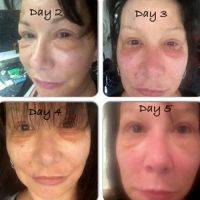 Lower Facelift Recovery Days 2-5