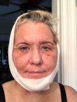 Lower Facelift Recovery Photos (10)
