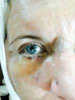 Lower Facelift Recovery Photos (11)