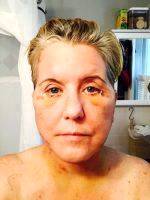 Lower Facelift Recovery Photos (12)