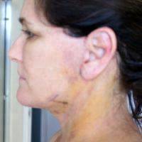 Lower Facelift Recovery Photos (26)