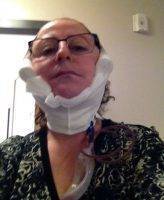Lower Facelift Recovery Photos (29)