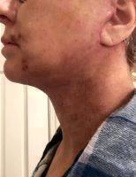 Lower Facelift Recovery Photos (36)