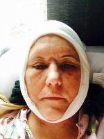 Lower Facelift Recovery Photos (9)