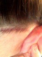 Lower Facelift Scar Behind Ear (1)