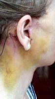 Lower Facelift Scar Behind Ear (2)
