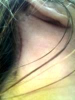 Lower Facelift Scar Behind Ear (3)