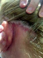 Lower Facelift Scar Behind Ear (8)