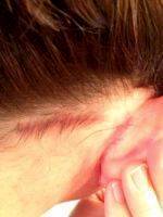 Lower Facelift Scar Behind Ear (9)