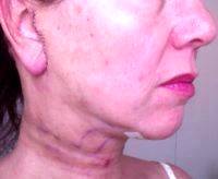 Lower Facelift Scar Depends On How Small The Stitches