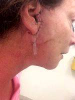 Lower Facelift Scar Pictures (5)