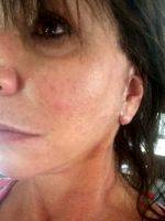 Lower Facelift Scar Pictures (6)