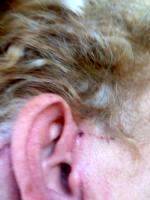Lower Facelift Scar Pictures (7)