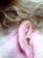Lower Facelift Scar Pictures (8)