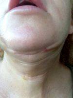 Lower Facelift Scar Pictures (9)