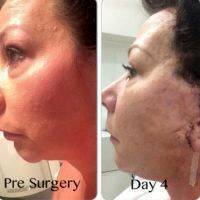 Lower Facelift Scars Day 4