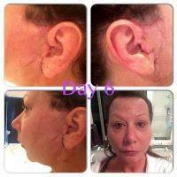 Lower Facelift Scars Day 6