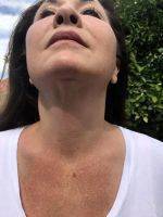 Lower Facelift Scars Under Chin (1)