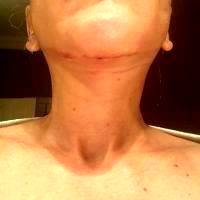 Lower Facelift Scars Under Chin (2)