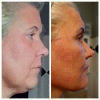 Lower Facelift Surgery Before And After Photo