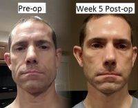 Male Facelift Preop And Post Op