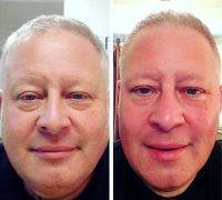 Male Microcurrent Face Lift Before And After